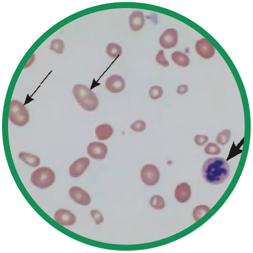 Dra. Rosana Schechter, Gastroenterologista especialista em Motilidade digestiva - Deficiência de B12