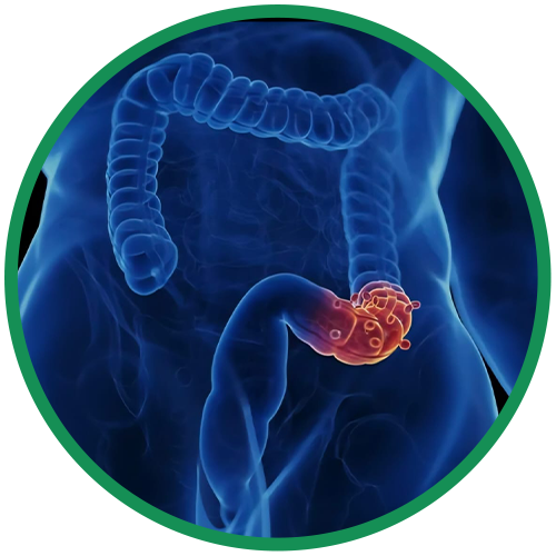 Dra. Rosana Schechter, Gastroenterologista especialista em Motilidade digestiva - Diverticulite