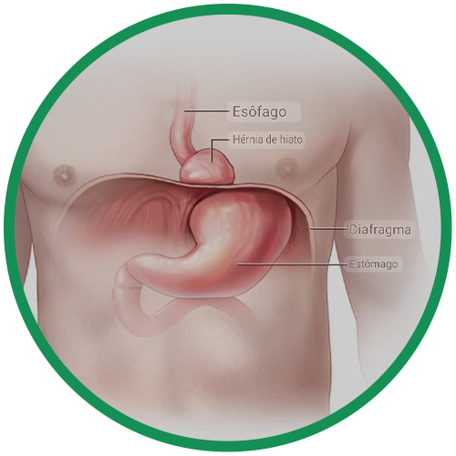 Dra. Rosana Schechter, Gastroenterologista especialista em Motilidade digestiva - Hernia de hiato