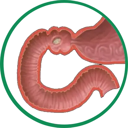 Dra. Rosana Schechter - Gastroenterologista em Israel, Especialista em doenças e motilidade digestiva - tratamento para Úlcera duodenal