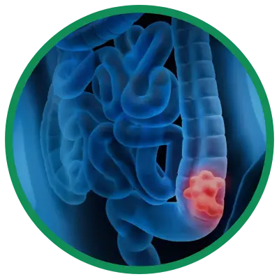 Dra. Rosana Schechter, Gastroenterologista especialista em Motilidade digestiva - Pólipos intestinais