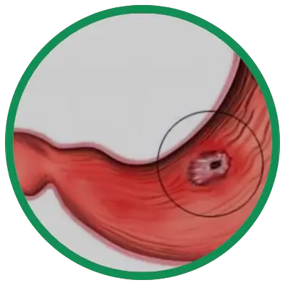Dra. Rosana Schechter, Gastroenterologista especialista em Motilidade digestiva - Úlcera gástrica